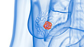 Breast cancer, illustration