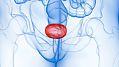 Inflamed bladder, illustration