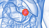 Kidney tumour, illustration