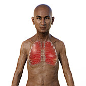 Man with miliary tuberculosis, illustration