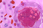 Acute lymphoblastic leukemia, illustration