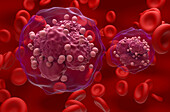 Acute lymphoblastic leukemia, illustration