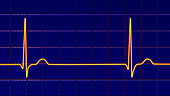 Junctional rhythm of the heartbeat, illustration