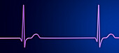 Junctional rhythm of the heartbeat, illustration