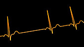 Sinus arrhythmia heartbeat rhythm, illustration