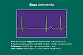 Sinus arrhythmia heartbeat rhythm, illustration