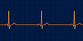 Sinus bradycardia heartbeat rhythm, illustration