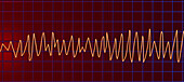 Torsades de pointes heartbeat rhythm, illustration