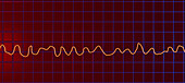 Ventricular fibrillation heartbeat rhythm, illustration