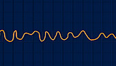 Ventricular fibrillation heartbeat rhythm, illustration