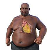 Overweight man with enlarged heart, illustration