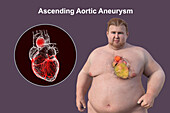 Obese man with ascending aortic aneurysm, illustration