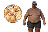 Overweight man with adipocytes, illustration