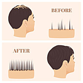 Hair loss treatment, conceptual illustration