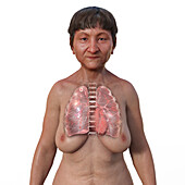 Lungs affected by apical tuberculosis, illustration
