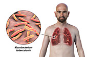 Cavernous tuberculosis, illustration
