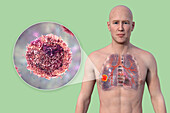 Lung cancer, illustration