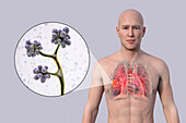 Lung mucormycosis lesion, illustration