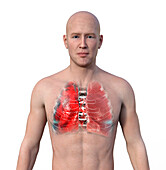 Lungs affected by pneumonia, illustration