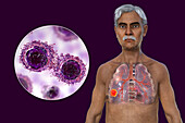 Lungs affected by lung cancer, illustration