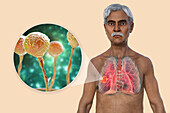 Lung mucormycosis lesion, illustration