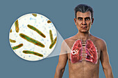 Lungs affected by cavernous tuberculosis, illustration