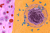 Rheumatoid arthritis, illustration