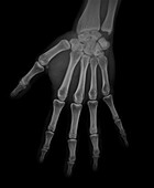 Healthy hand, X-ray