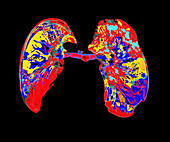 Healthy lungs, CT scan