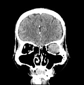 Orbital tumour, CT scan