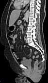 Prolapsed uterus, CT scan