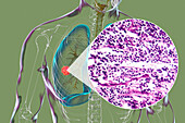 Lung cancer tumour and light micrograph, illustration