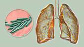 Lungs affected by miliary tuberculosis, illustration
