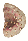 Peritoneal tuberculosis, illustration