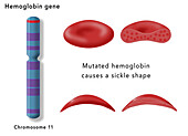 Sickle cell disease, illustration