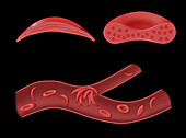 Normal blood cell and sickle cell disease, illustration