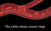 Blood vessel obstructed by sickle cells, illustration
