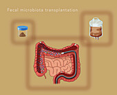 Faecal microbiota transplantation, illustration