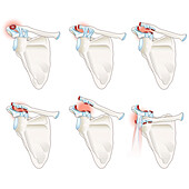 AC joint separation, illustration