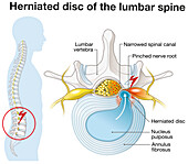 Herniated disc of the lumbar spine, illustration