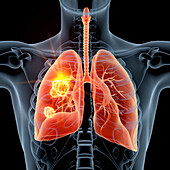 Carcinoma in right lung, illustration