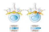 Normal disc and herniated disc, illustration