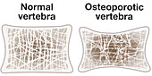 Osteoporosis and normal vertebra, illustration