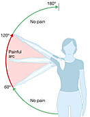 Shoulder impingement, illustration