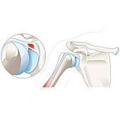 SLAP lesion of the shoulder, illustration