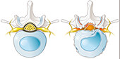 Spinal canal stenosis, illustration