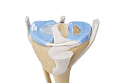 Bucket handle tear meniscus, illustration