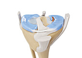 Flap tear meniscus, illustration