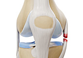 Medial collateral ligament tear, illustration