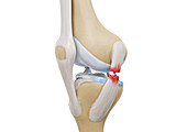 Medial collateral ligament tear, illustration